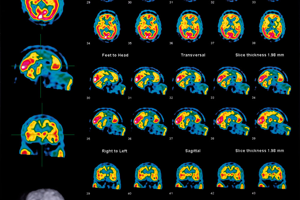 scintigraphie cerebrale