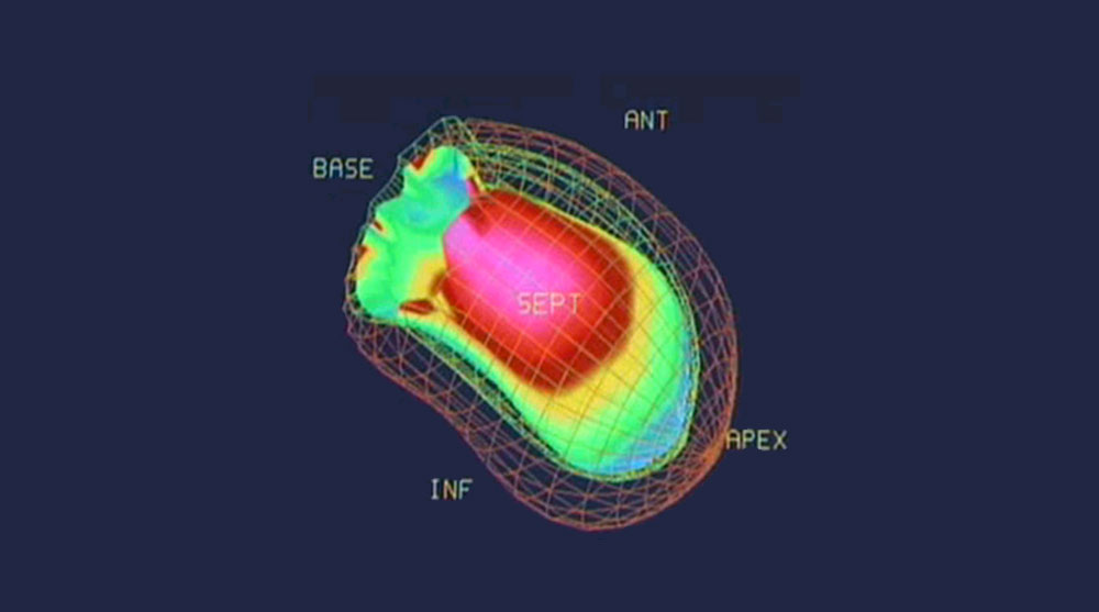 ventriculo isotopique
